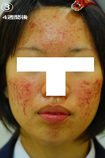 4週間後