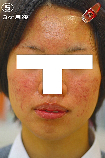 3ケ月後