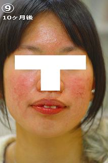 10ケ月後