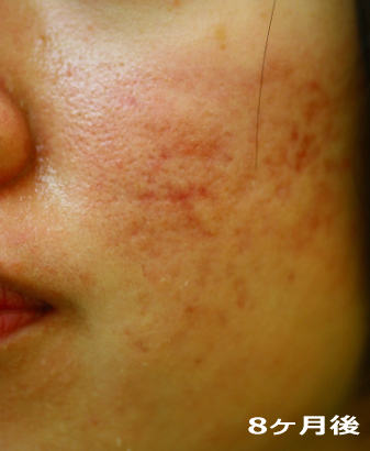 8ケ月後