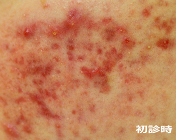 初診時