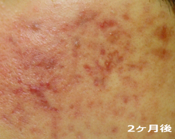 2ヶ月後