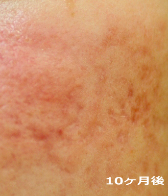 10ケ月後