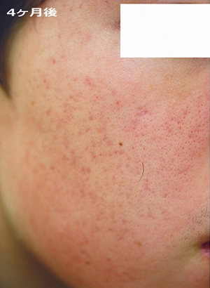 4ケ月後