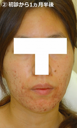 初診から1ヵ月半後
