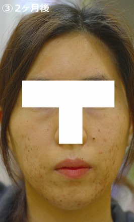 2ケ月後