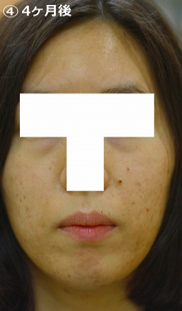 4ケ月後