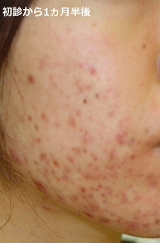初診から1ヵ月半後