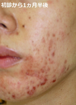 初診から1ヵ月半後
