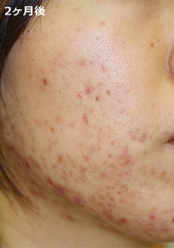 2ケ月後