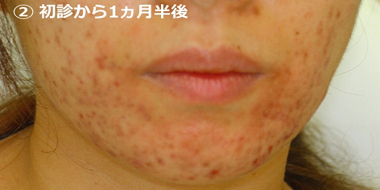初診から1ヵ月半後